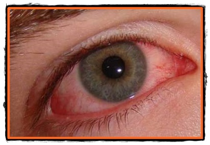 Vedere neclară - semne și simptome - Conjunctivita a pierdut vederea