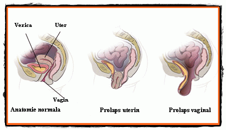 Prolapsul genital - Prof. Dr. Bratila